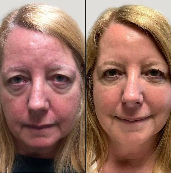 Facial Treatment | Plasma Pen | Case 3
