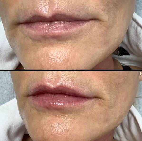 Fuller Lips With Lip Filler - Hydrated lips