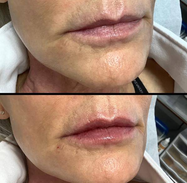 Fuller Lips With Lip Filler - increase vertical lip height