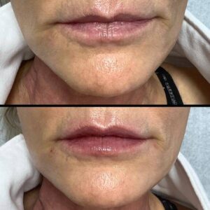 Fuller Lips With Lip Filler