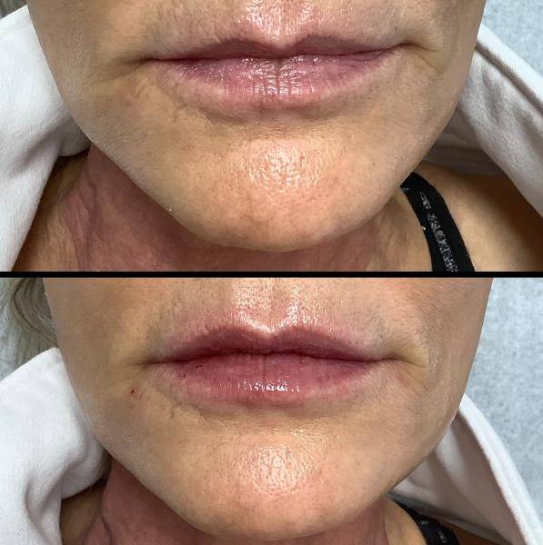 Fuller Lips With Lip Filler - increase vertical lip height