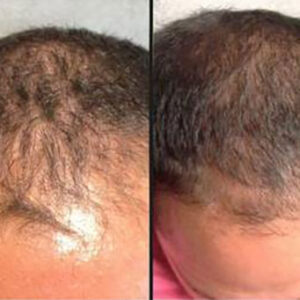 Injectable For Hair | PRP | Case 1