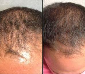 Injectable For Hair | PRP | Case 1