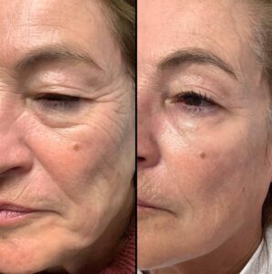 Injectable | Sculptra | Case 2