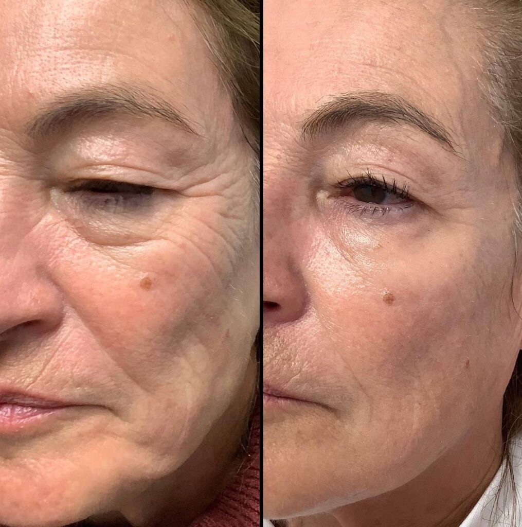 Injectable | Sculptra | Case 2