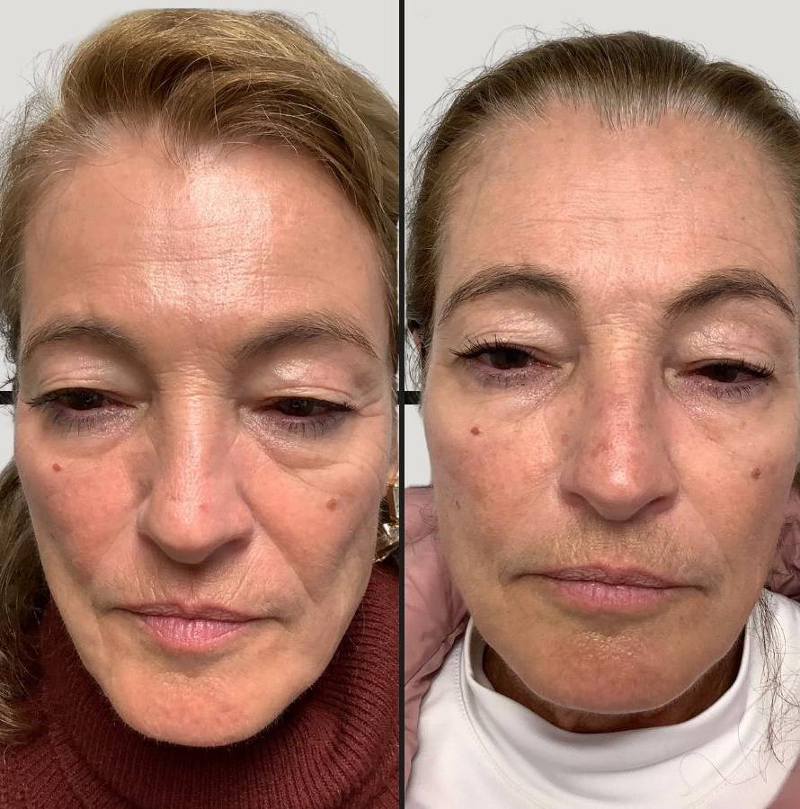 Injectable | Sculptra | Case 2