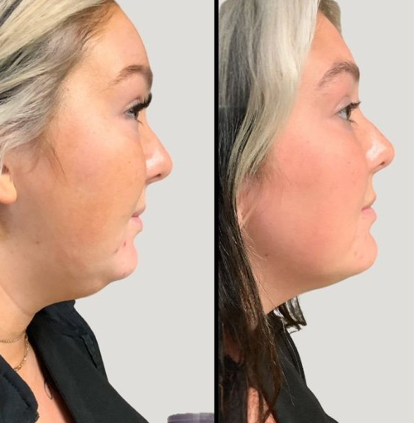 Injectable kybella 1