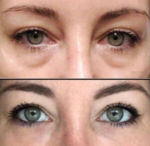Injectables for Eyes | Filler | Case 1