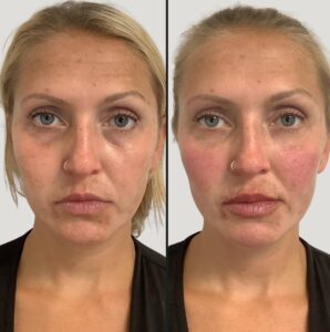 Injectables For Face | Botox | Case 4