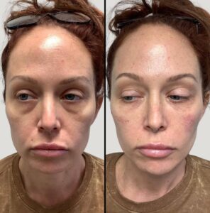 Injectables for Face | EZGel Fillers | Case 2