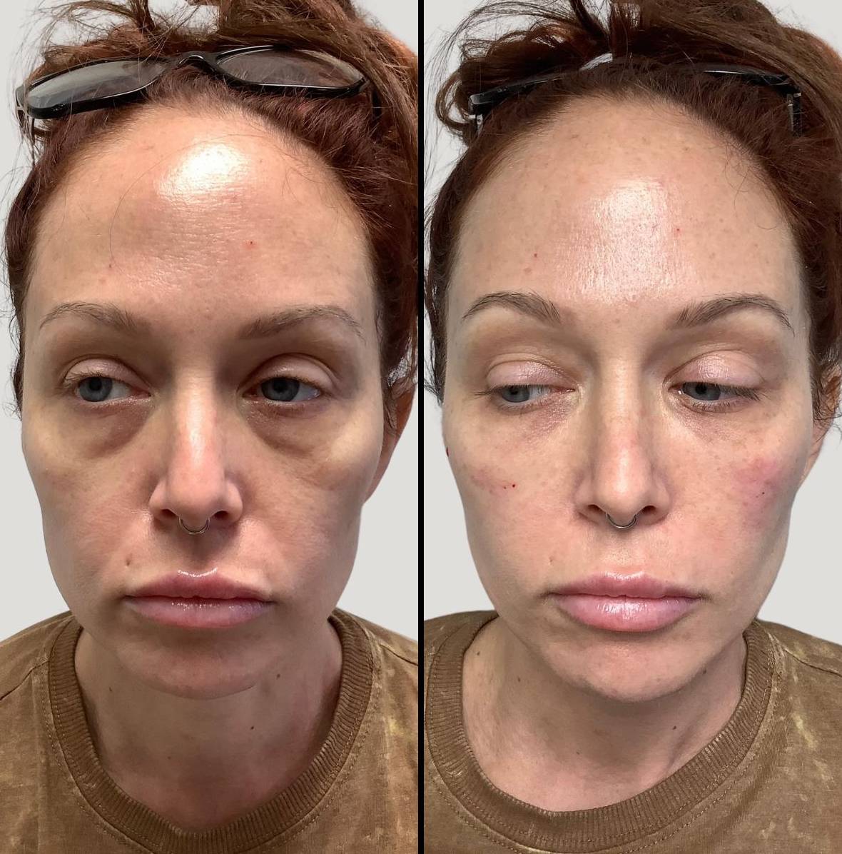 Injectables for Face | EZGel Fillers | Case 2