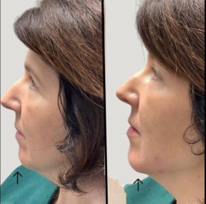 Injectables For Chin | Filler | Case 4