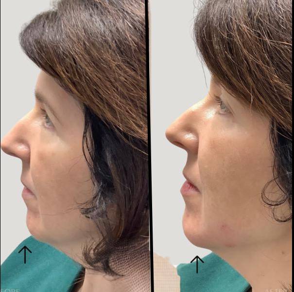 Injectables For Chin | Filler | Case 4