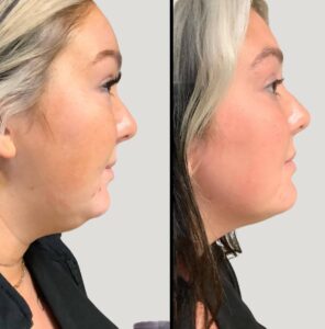 Injectables For Chin | Kybella | Case 3