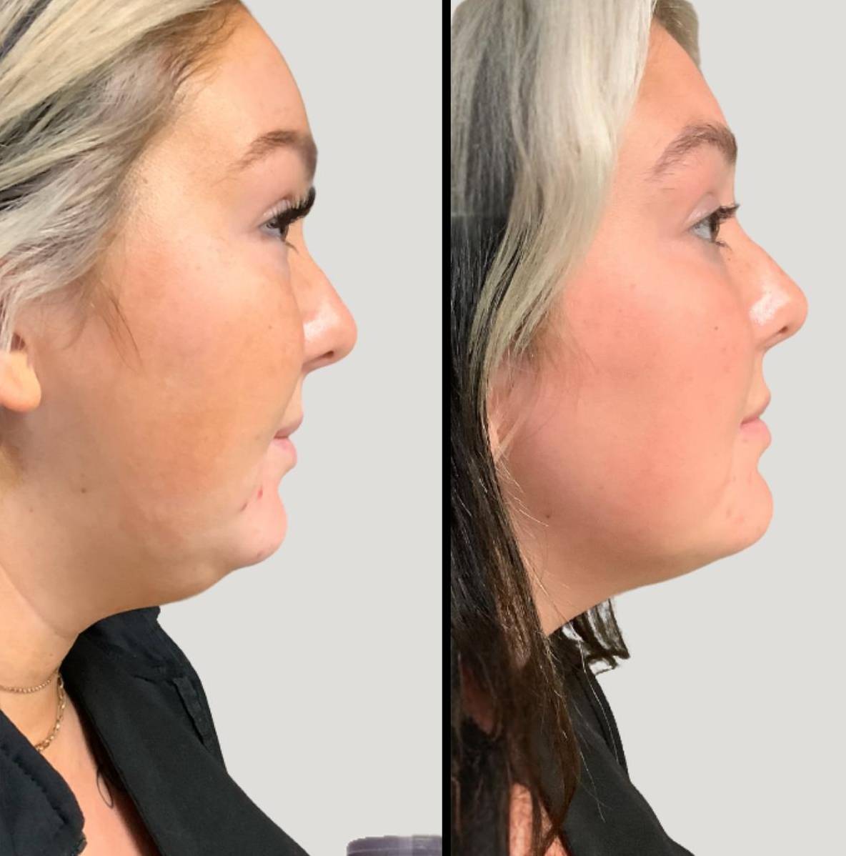 Injectables For Chin | Kybella | Case 3