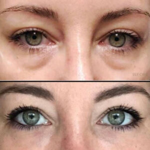Injectables For Eyes