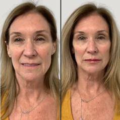 Injectables For Face | Dermal Filler Case