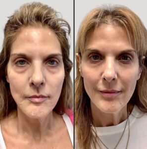 Injectables For Face | EZGel Fillers | Case 5