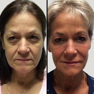 Injectables For Face | Fillers | Case 8