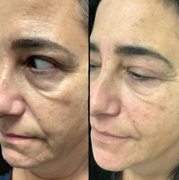 Injectables For Face | Skinvive | Case 7