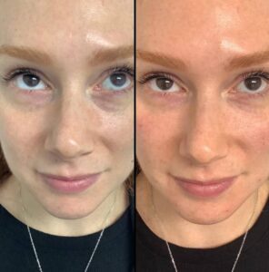 Injectables For Face | EZGel Fillers | Case 3
