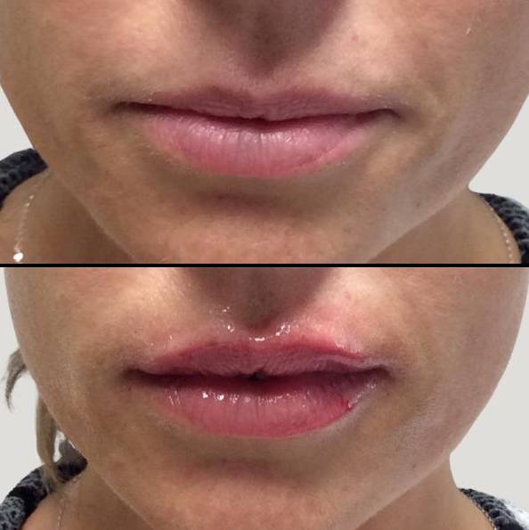Injectables For Lips | Filler | Case 3