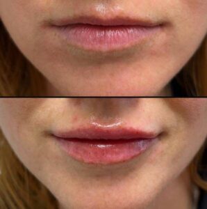 Injectables For Lips | Filler | Case 4