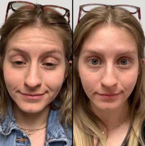 Injectables For Forehead | Botox | Case 1