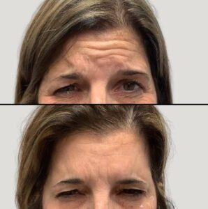 Injectables for Forehead | Botox | Case 3