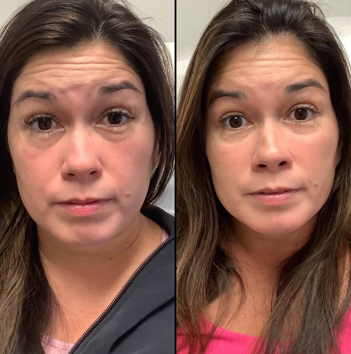 Injectables Full Face Facial Balance Case1b