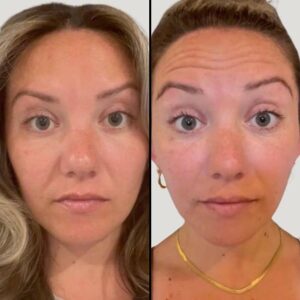 Injectables For Forehead | Botox | Case 5