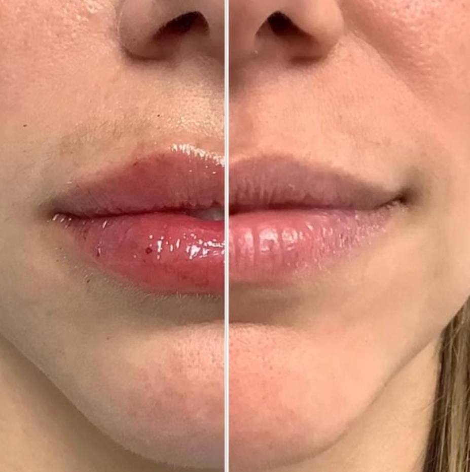 Injectables For Lips | Filler | Case 2