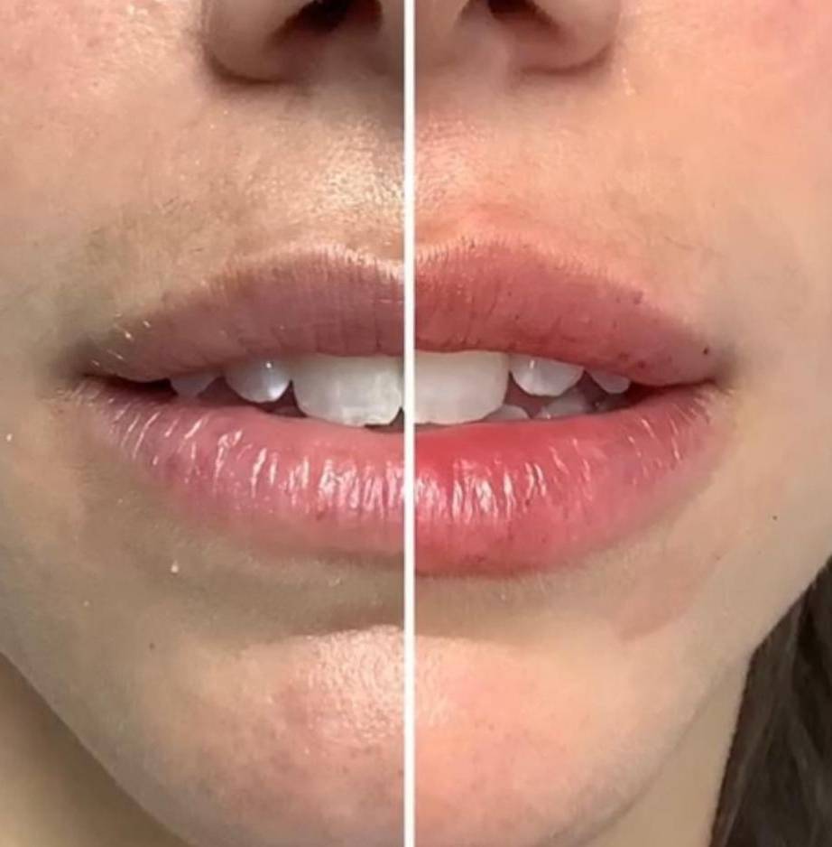 Injectables For Lips | Filler | Case 2