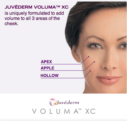 JuvedermVoluma_FaceDiagram