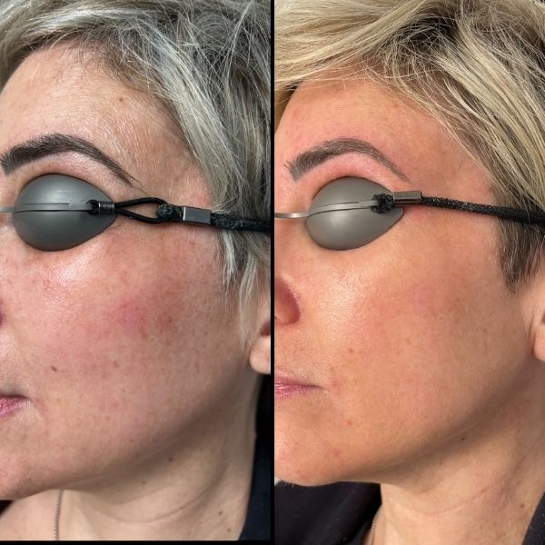 Laser-3D Rejuvenation