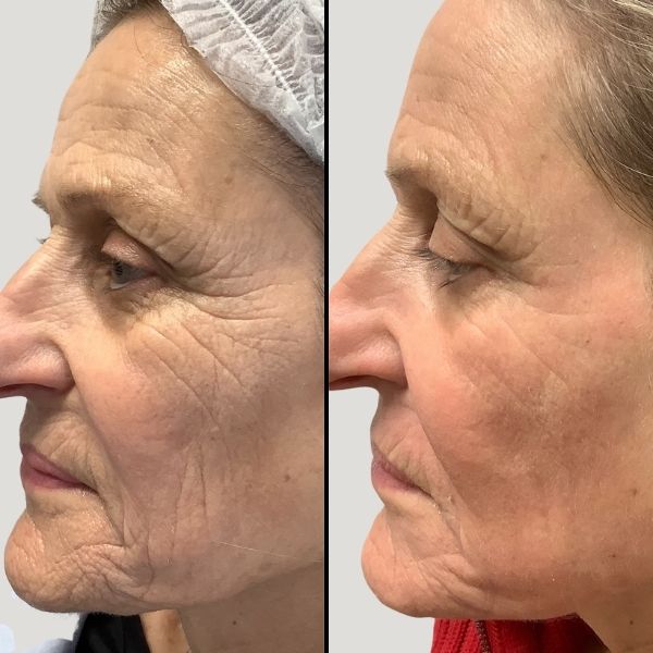 Laser-Pearl Fractional