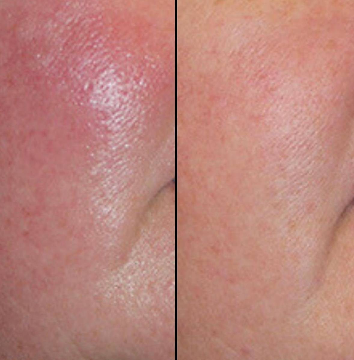 Laser Skin Resurfacing | Case 1 - cheek