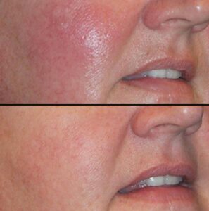 Laser Skin Resurfacing | Case 1