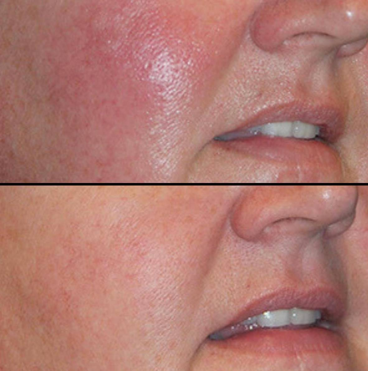 Laser Skin Resurfacing | Case 1