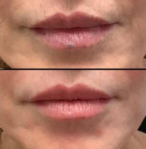 Laser Vein Removal | Case 1