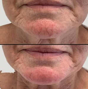 Laser Vein Removal | Case 2