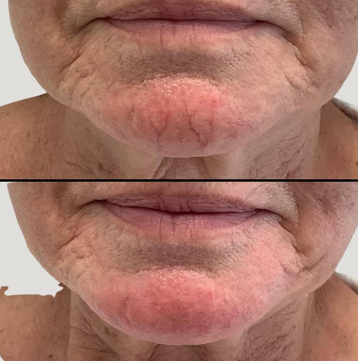 Laser Vein Removal | Case 2