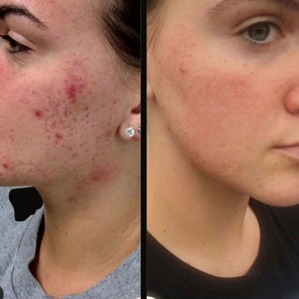 Laser Acne Treatment