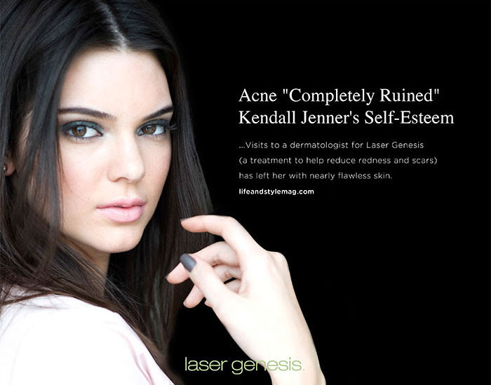 Acne "Completely Ruined" Kendall Jenner's Self-Esteem