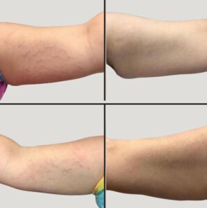 Lasers For Body | Vivace MNRF | Case 1