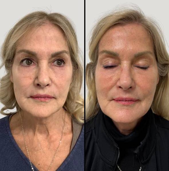 Lasers For Face | CO2 | Case 1 - front