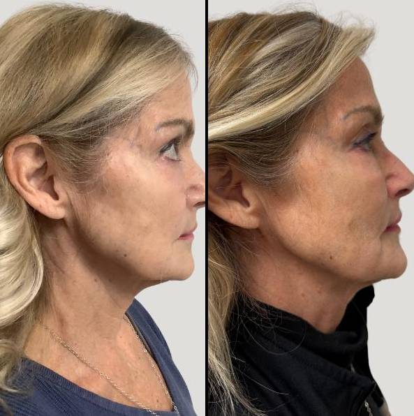 Lasers For Face | CO2 | Case 1 - right side