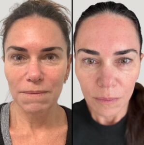Lasers For Face | CO2 | Case 2