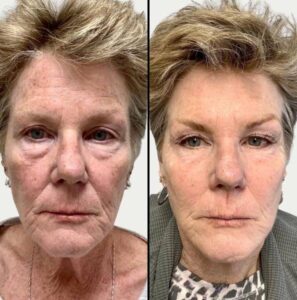 Lasers For Face | MNRF Vivace | Case 3
