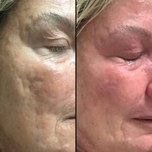 Lasers For Face | Pearl Fractional | Case 4